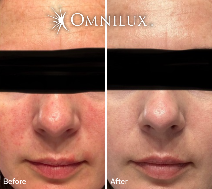 Omnilux Contour™ Face LED Mask — Preorder