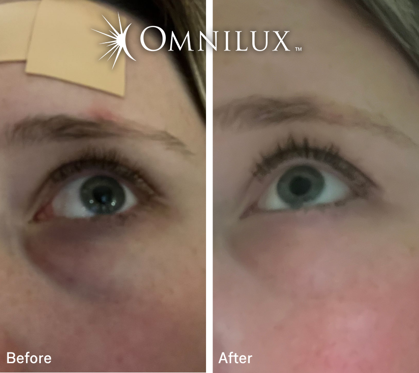 Omnilux Eye Brightener — Preorder