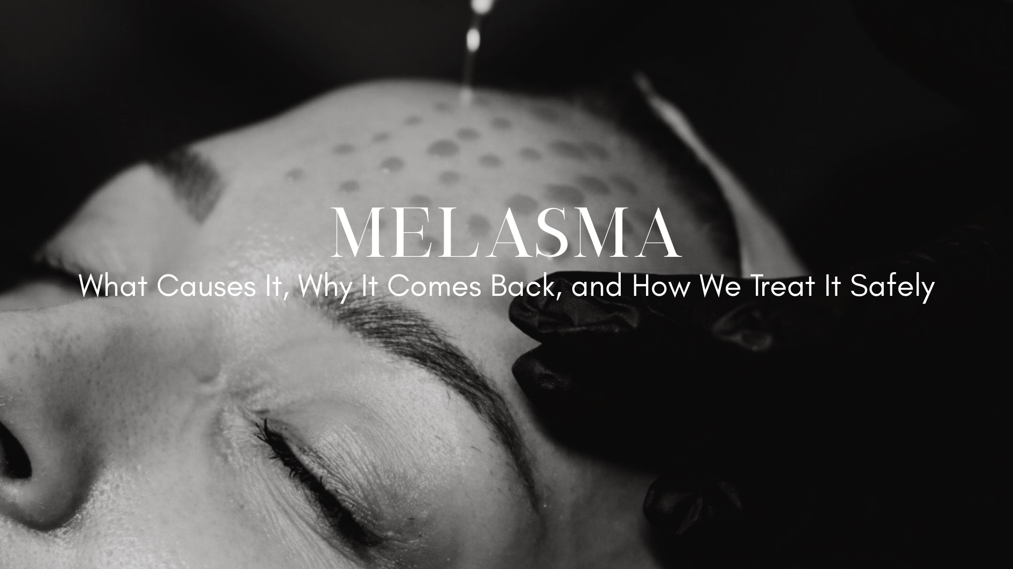 Melasma: What Causes It, Why It Comes Back, and How We Treat It Safely at The Glow Lab