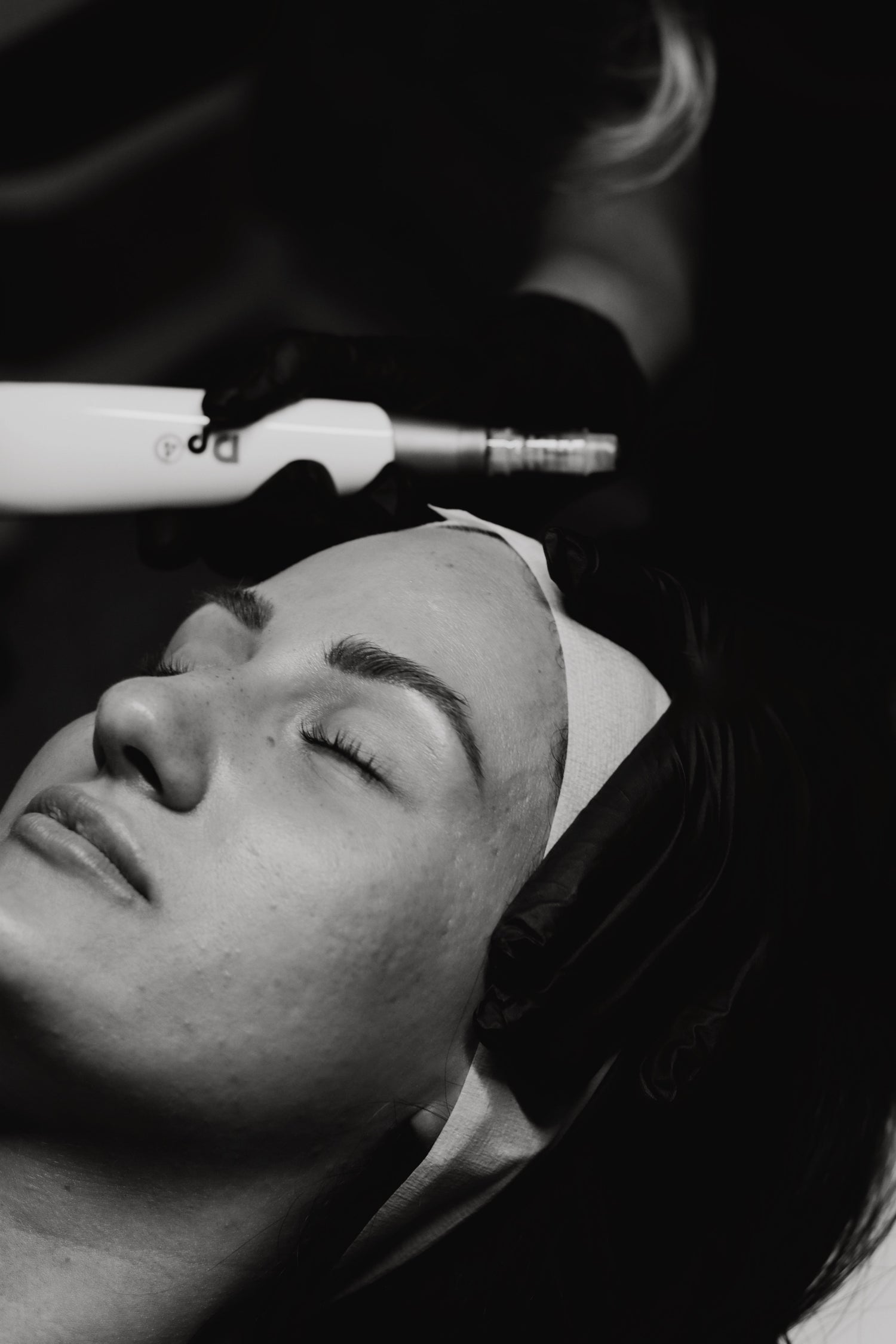 Dp4 Microneedling