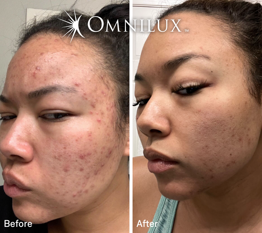 Omnilux Clear™ LED Mask — Preorder