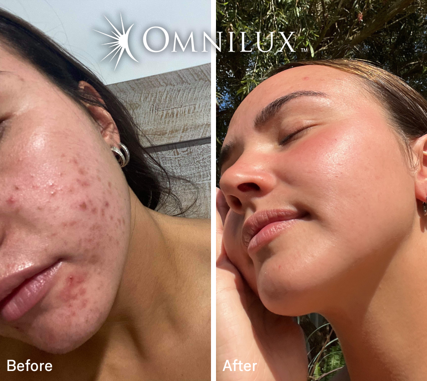 Omnilux Clear™ LED Mask — Preorder