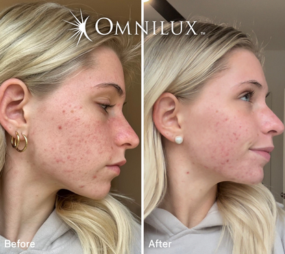 Omnilux Clear™ LED Mask — Preorder