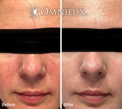 Omnilux Contour™ Face LED Mask — Preorder
