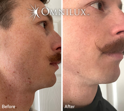 Omnilux Men™ Face LED Mask — Preorder