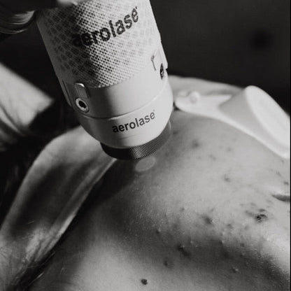 An acne treatment at The Glow Lab, Langley BC