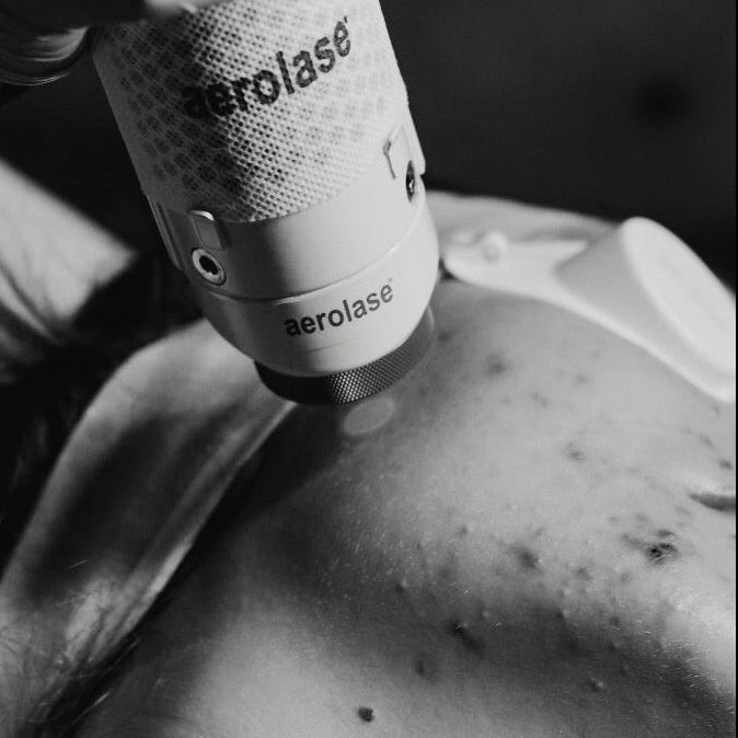 Clear Plan The Reset, acne oxygen peel at The Glow Lab, Langley BC