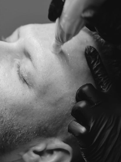 Pigment and rosacea treatment at The Glow Lab, Langley BC