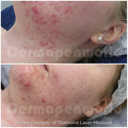 Acne before and after microneedling at The Glow Lab